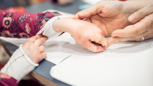 Hands with fused fingers of a child with Epidermolysis Bullosa