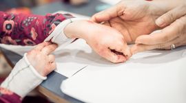 Hands with fused fingers of a child with Epidermolysis Bullosa