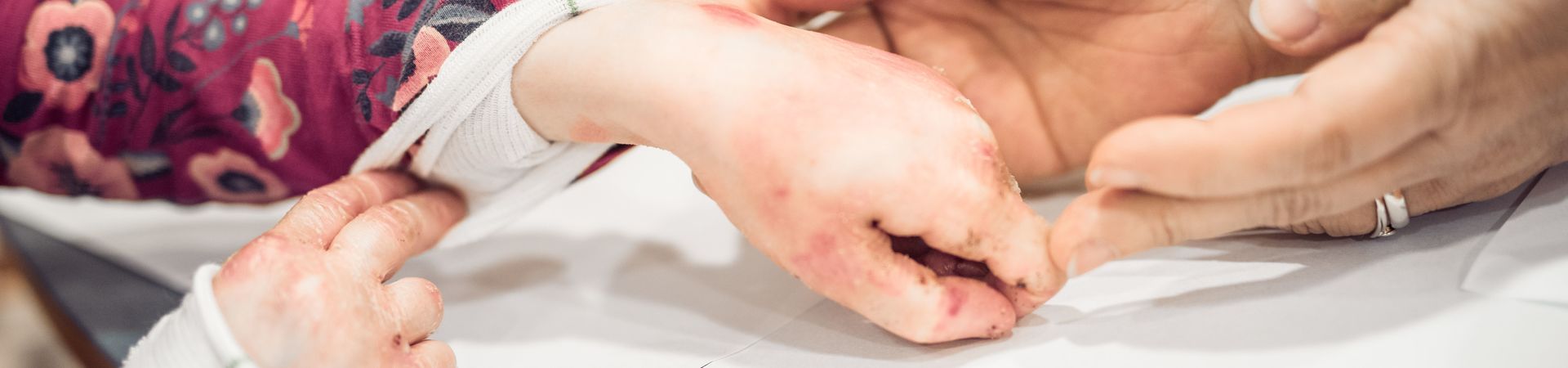 Hands with fused fingers of a child with Epidermolysis Bullosa