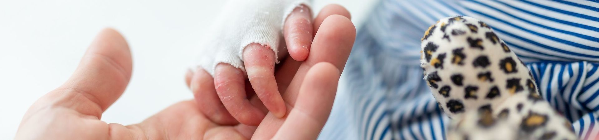 Hand in dressings of a child with EB being hold by the hand of a care person